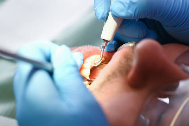 Best Emergency Root Canal Treatment in Beardstown, IL