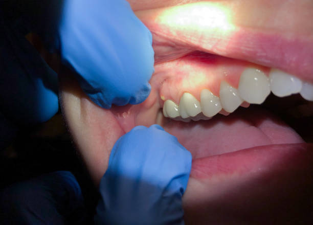 Best Urgent Dental Care for Toothache in Beardstown, IL